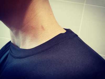 Hickie